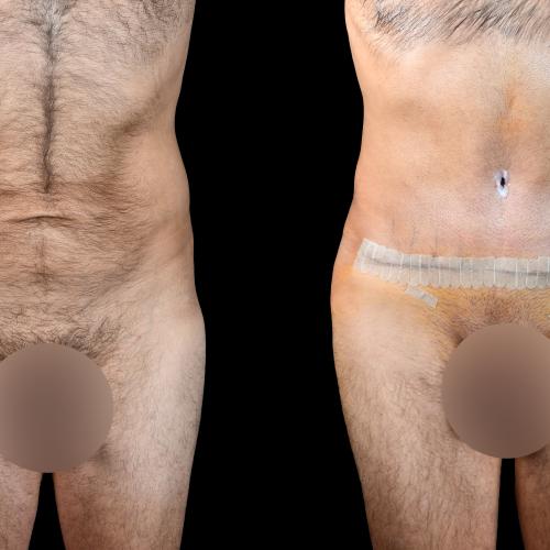 Traitement de la Gynécomastie (avec liposuccion) Photos avant & après